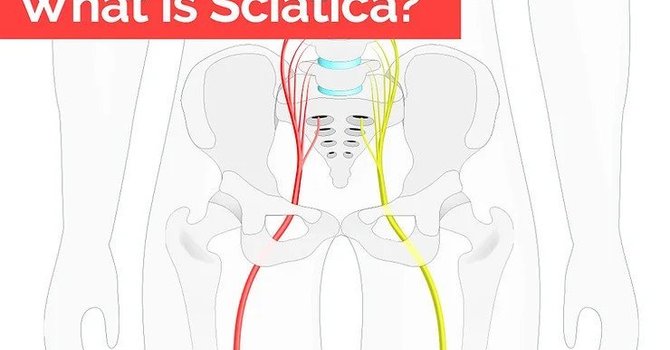 What is Sciatica? image
